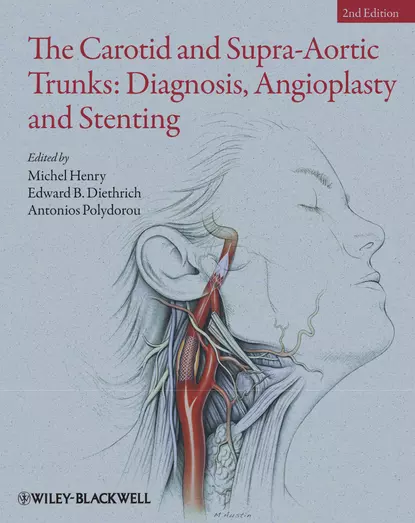 Обложка книги The Carotid and Supra-Aortic Trunks. Diagnosis, Angioplasty and Stenting, Michel  Henry