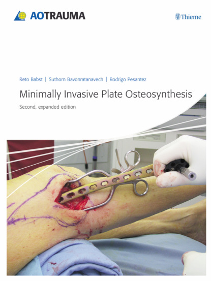 Reto Babst - Minimally Invasive Plate Osteosynthesis (MIPO)