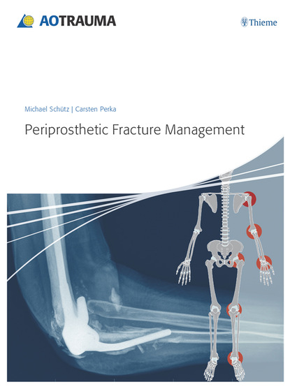 Carsten  Perka - Periprosthetic Fracture Management