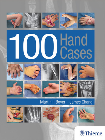 

100 Hand Cases
